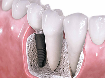 Prótese total implanto-suportada e implanto-retida, fixada sobre 4 a 8 implantes em média, este tipo de prótese é parafusada e retirada apenas pelo seu dentista, é uma prótese que confere boa estética 