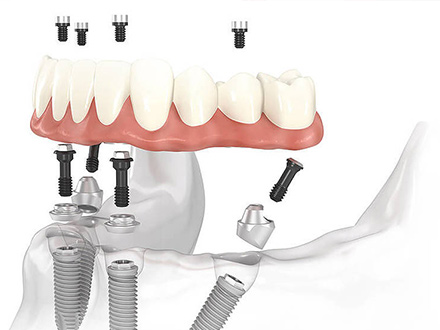 Prótese total implanto-suportada e implanto-retida, fixada sobre 4 a 8 implantes em média, este tipo de prótese é parafusada e retirada apenas pelo seu dentista, é uma prótese que confere boa estética 