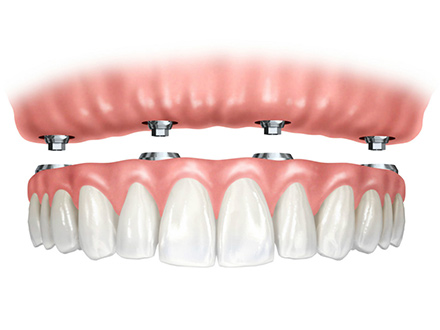 Prótese total removível sobre implante, este tipo de prótese é mais barata que a prótese protocolo porque exige menos implantes (2 a 6 em média) e é confeccionada em resina.