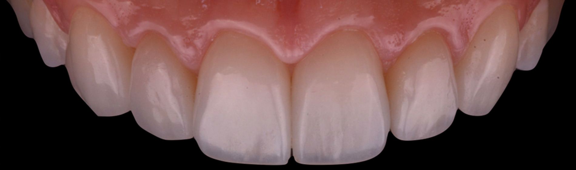 Lentes de Contato Dental em Taguatinga. O Tratamento estético odontológico com lentes de contato dental são capazes de transformar completamente o seu sorriso em poucos dias. Conheça o diferencial da Rame em Taguatinga