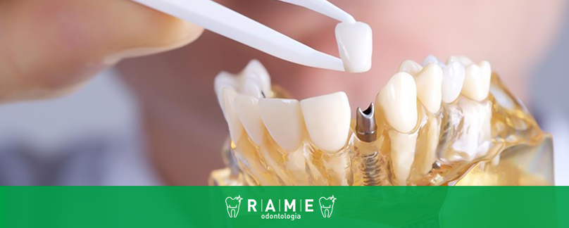 Conheça alguns tipos de implantes dentários que podem ser realizados na clínica RAME Odontologia em Taguatinga.